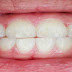 मसूड़ों की सूजन दूर करने के घरेलू उपचार | Home remedies for gingivitis in hindi
