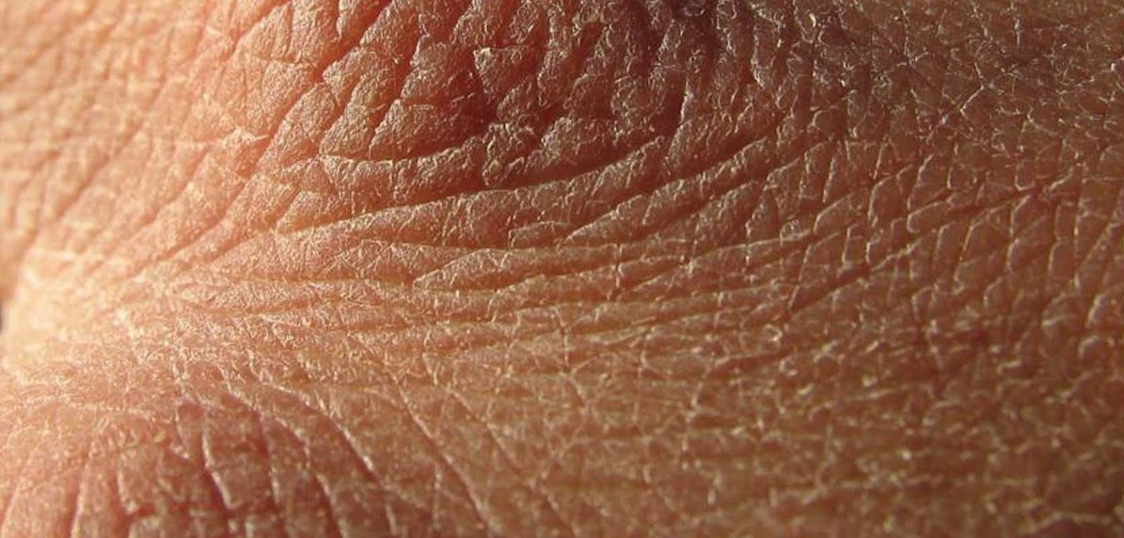 Kulit Kering Mengganggu Aktivitasmu? Atasi Saja Dengan Tips Berikut Ini ...