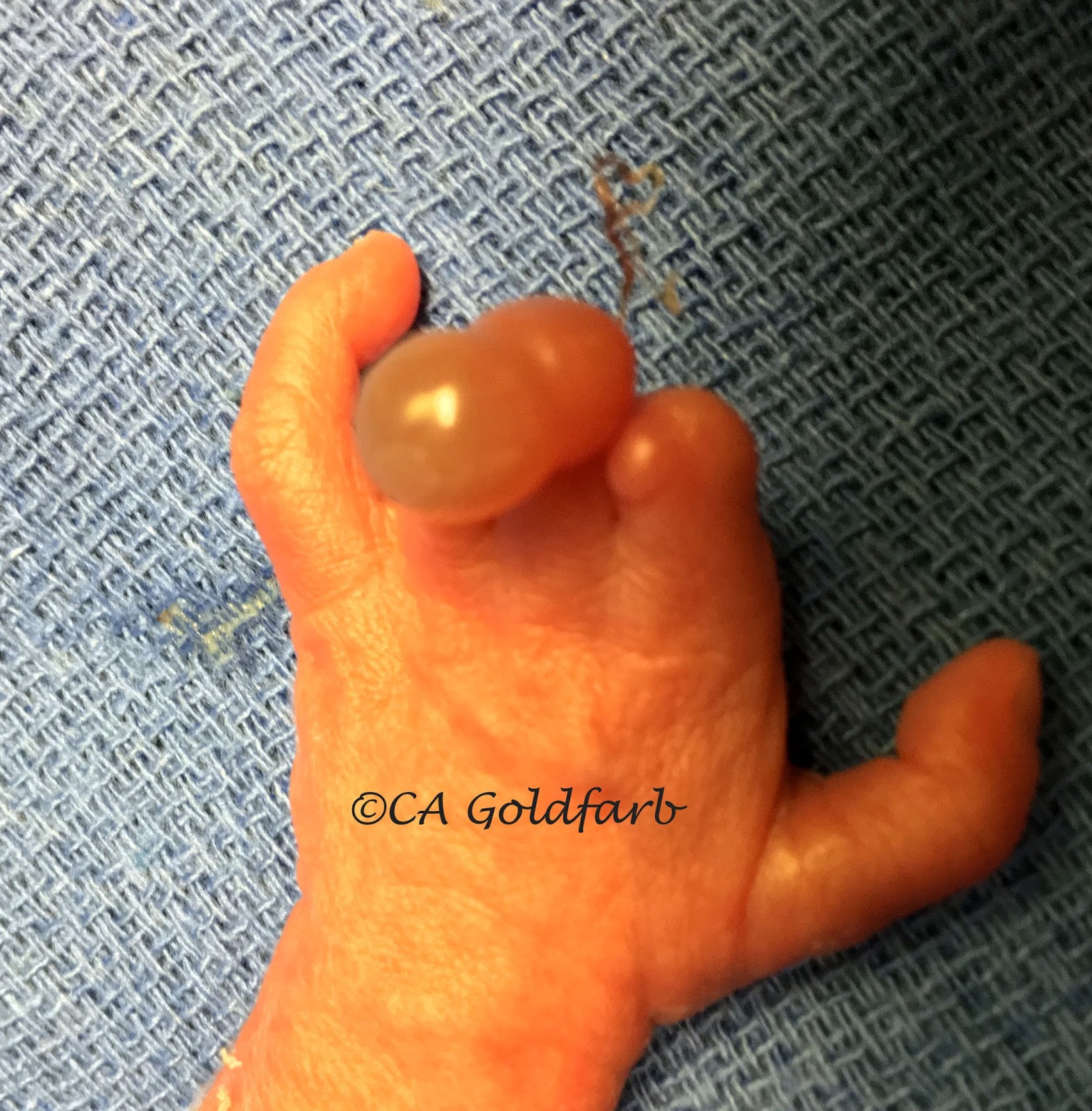 Finger at Risk Amniotic Constriction Band Congenital Hand and Arm