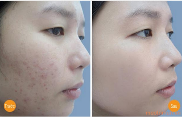 Review kem trị mụn Neutrogena On the Spot Acne Treatment