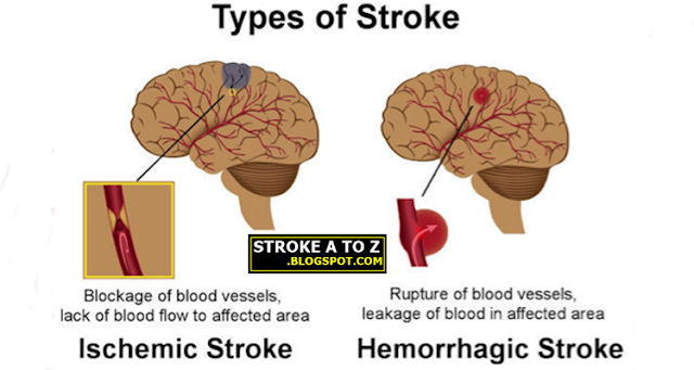 Jenis-jenis Penyakit Stroke Jenis-jenis Penyakit Stroke