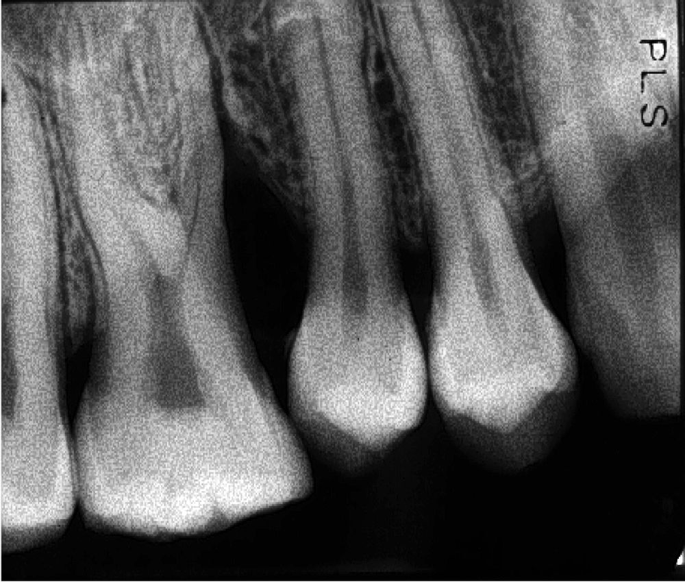 Intraoral Radiography Technique Errors Directorio Odontológico