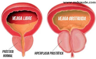 tipos de prostata inflamada