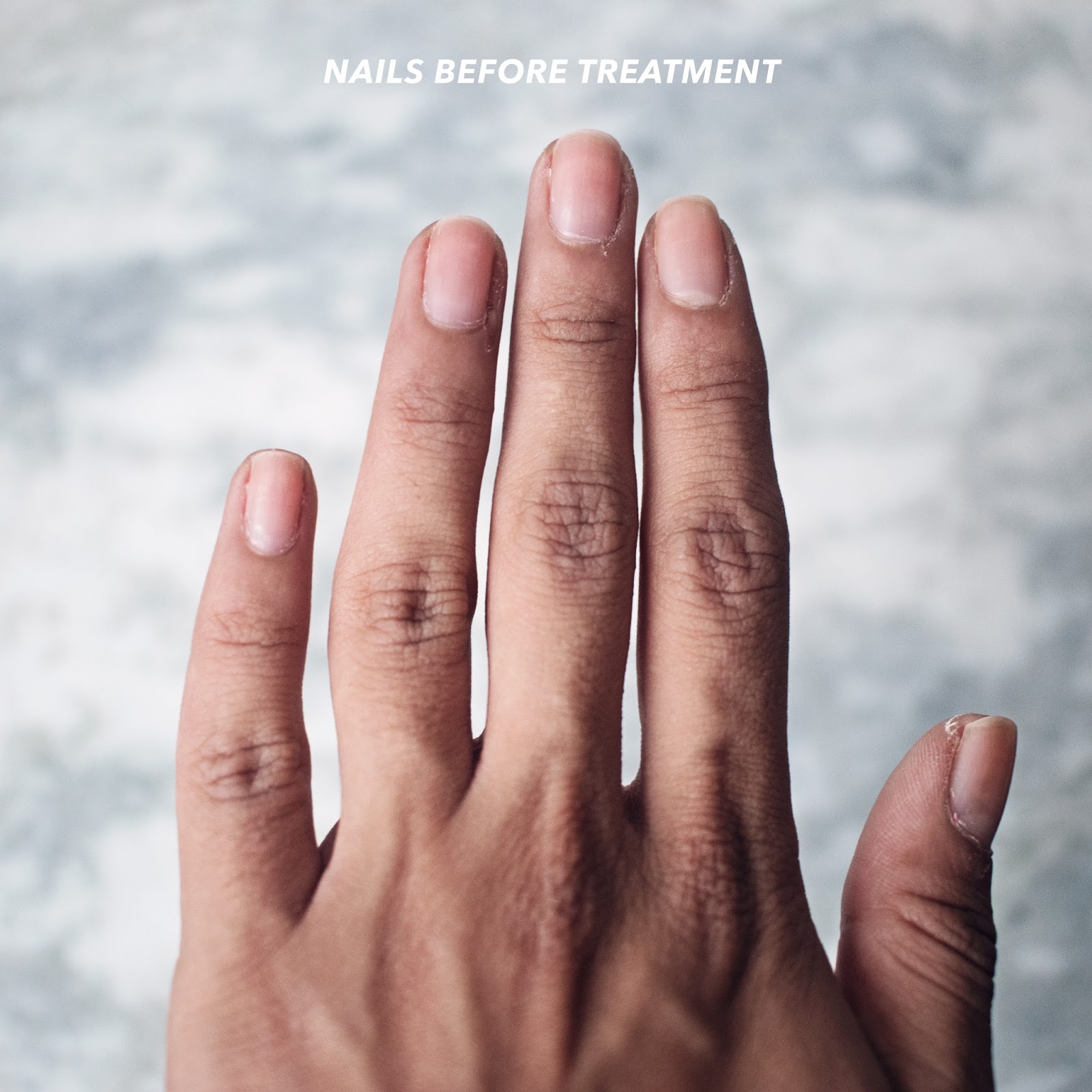 Dry Cuticles And Skin Around Nails Nail Ftempo