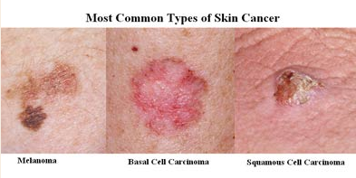 Best Hospitals For Cancer Treatment : Skin Cancer Treatment in India