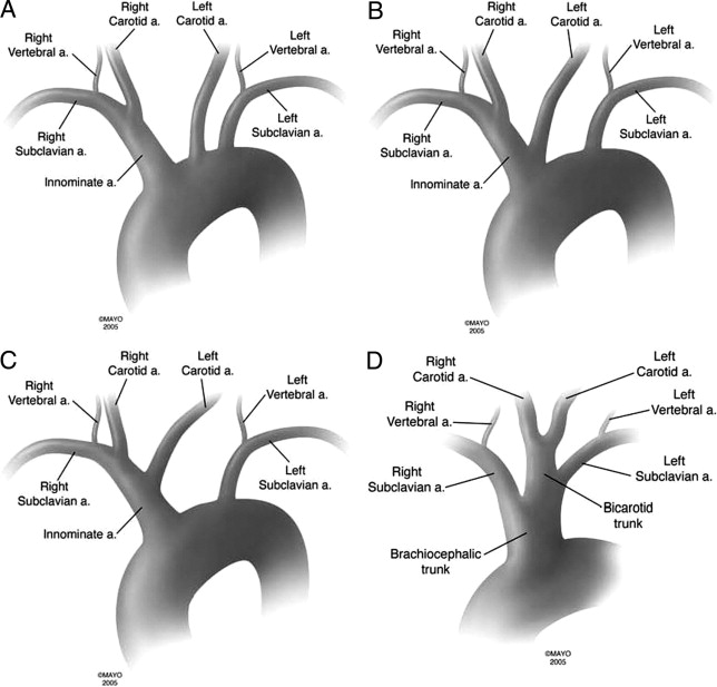 Vascular Mind ANATOMICAL VARIANTS OF AORTIC ARCH BRANCHES VARIANTES vascular-mind-anatomical-variants-of-aortic-arch-branches-variantes
