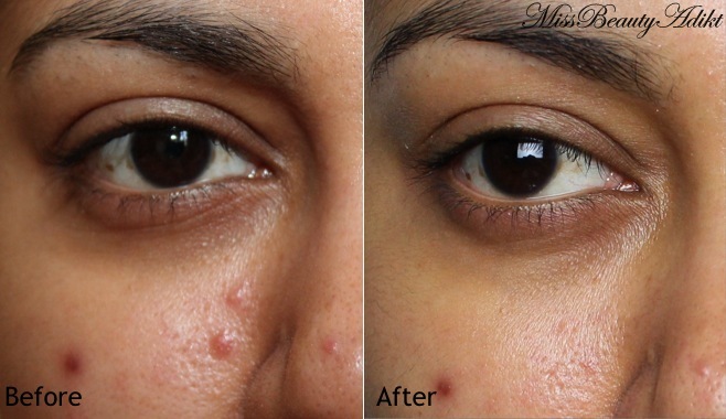 La Roche Posay Effaclar Duo Before After