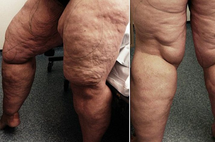 Lipedema ejercicios