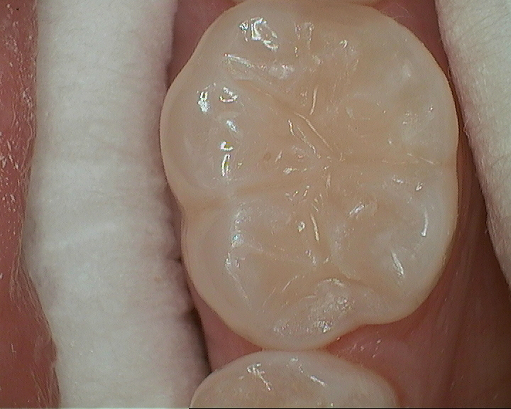 sweet tooth: occlusal caries