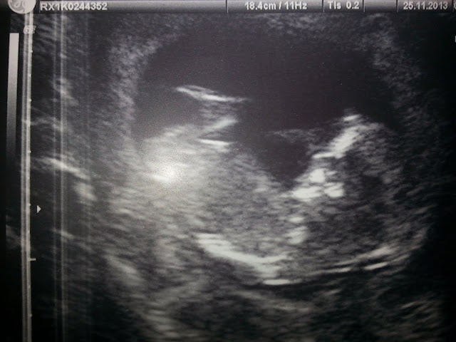 Baby scan photo