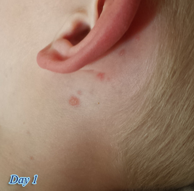 Day 1 of Chicken Pox Spots