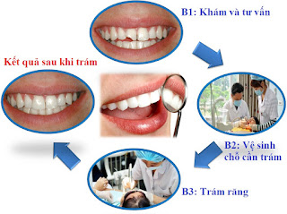 Quy trình trám răng áp dụng cho trường hợp nào Quy-trinh-tram-rang-uy-tin-tai-nha-khoa-Duy-Hung