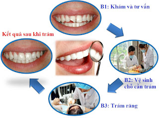 Quy trình trám răng thẩm mỹ