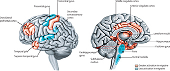 Presión arterial y lesiones cerebrales de la sustancia blanca