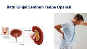 Foto Solusi Untuk atasi batu ginjal sembuh tanpa operasi