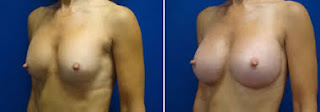 Augmentation mammaire pour Femme marié  avant et après