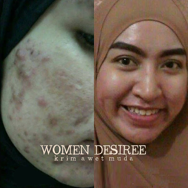 Hapus jerawat guna detox mungkin lambat, calit WD je. Hapus jerawat guna detox mungkin lambat, calit WD je.