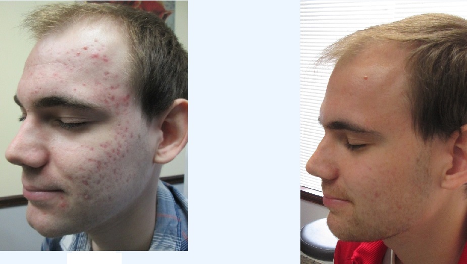 Your Skin for Life Laser Treatments for Acne and Acne Scarring