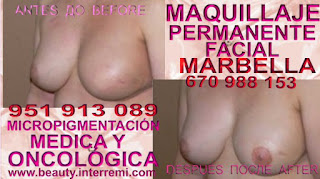 Cáncer de mamas Cáncer de mamas Rellenos de la areola mamaria posteriormente de mastectomia