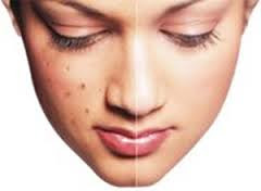 Tratamientos caseros del acné