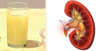 Do You Have Stones in Your Kidneys? Eliminate Them Till The Last Stone Easily With a Single Fruit Do You Have Stones in Your Kidneys? Eliminate Them Till The Last Stone Easily With a Single Fruit