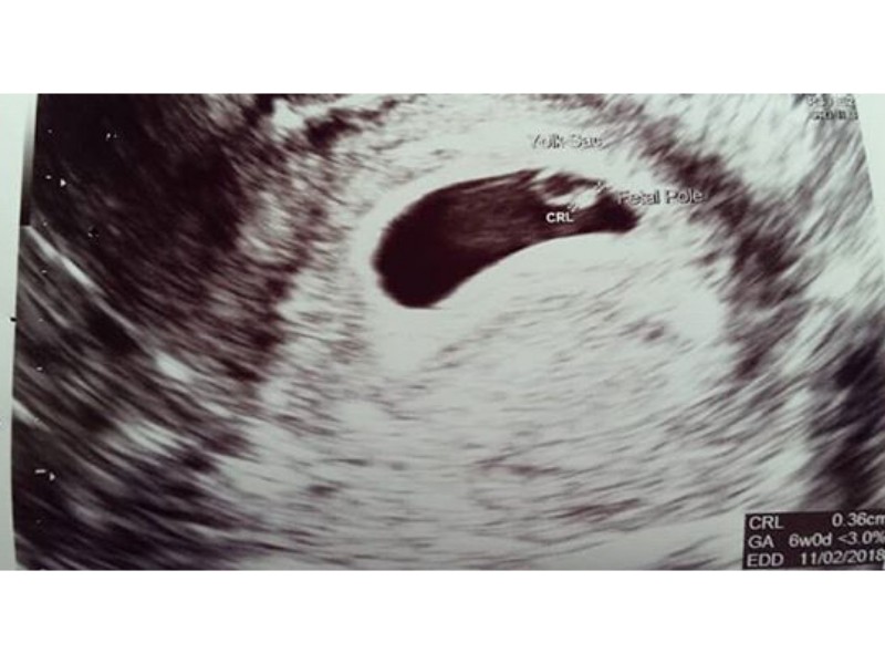 6 Haftalık Gebelik (Hamilelik) Ultrason Görüntüleri Gebelik Görüntüsü