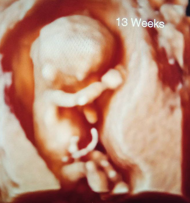 13 Haftalık Gebelik Ultrason Görüntüsü