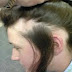 Alopecia Areata: Causes, Symptoms, Diagnosis, Treatments, and Tips to Cope