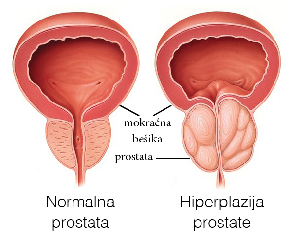 Prostatitis napon