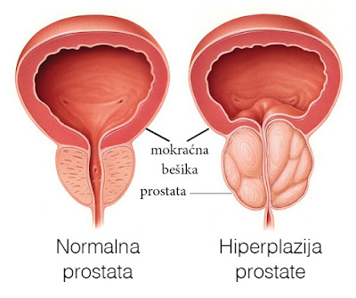 Hiperplazija prostate
