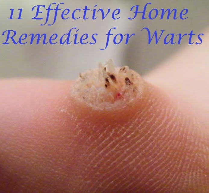 Pull Out Plantar Wart Root