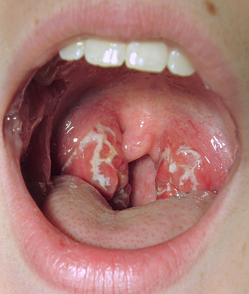 Strep Throat Symtoms 107