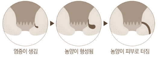 치루 치루