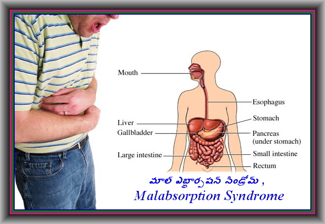 మాల్‌ ఎబ్జార్పషన్‌ సిండ్రోమ్‌ , Malabsorption Syndrome