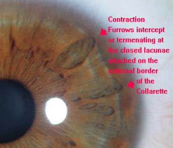 Modern &amp; Multidimensional Iridology: Contraction Furrows Intercepting