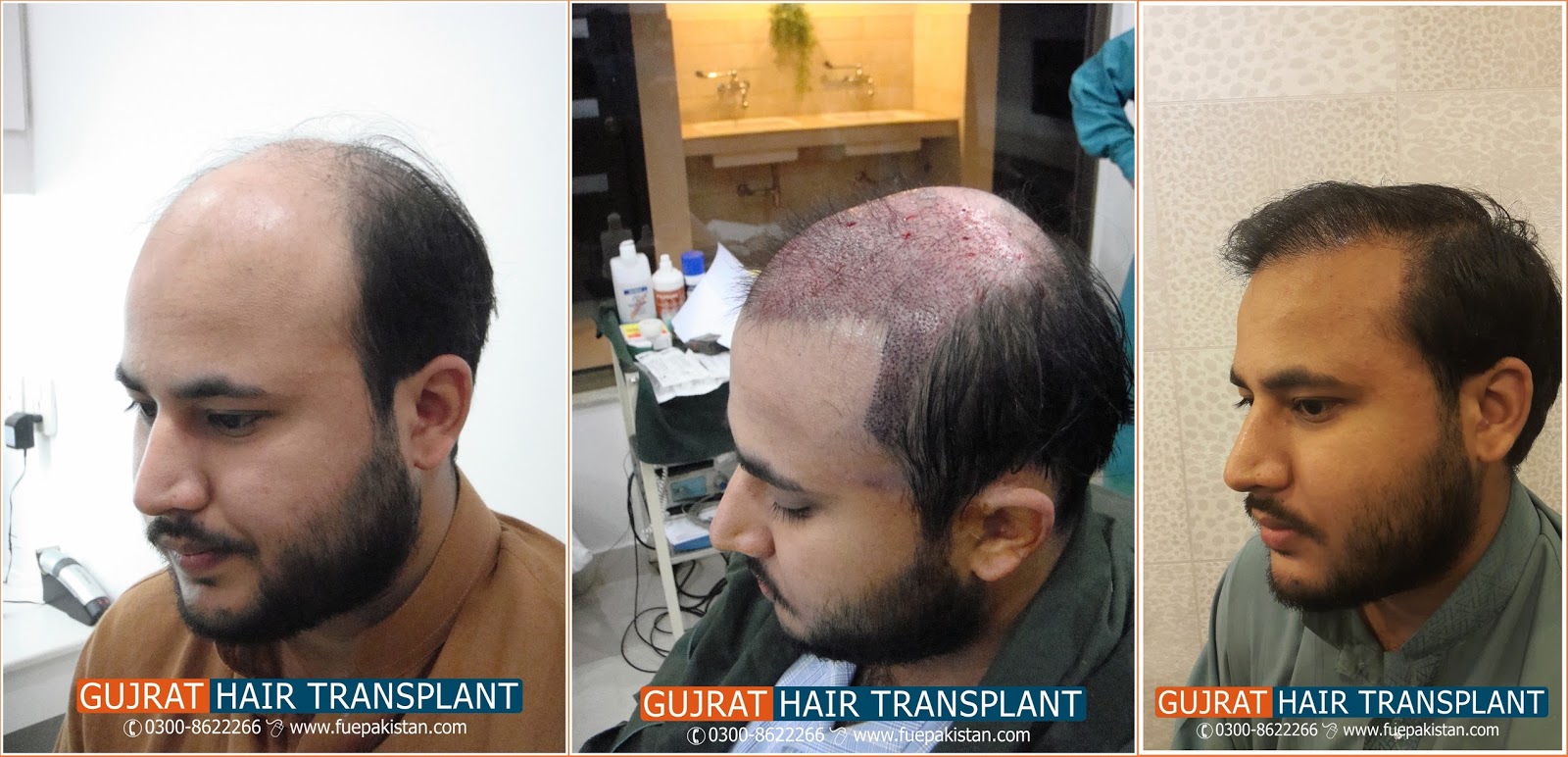 Hair Transplant in Pakistan,FUE in Pakistan fue hair transplant clinic