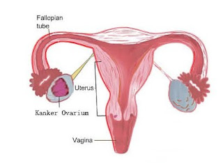 obat kanker ovarium