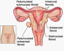 pengobatan alternatif mioma uteri