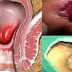 Obat Wasir Mujarab thumbnail