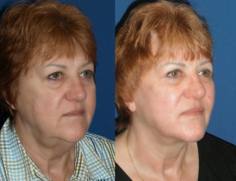 Medical Treatment Picturesfor Better Understanding Mini Face Lift