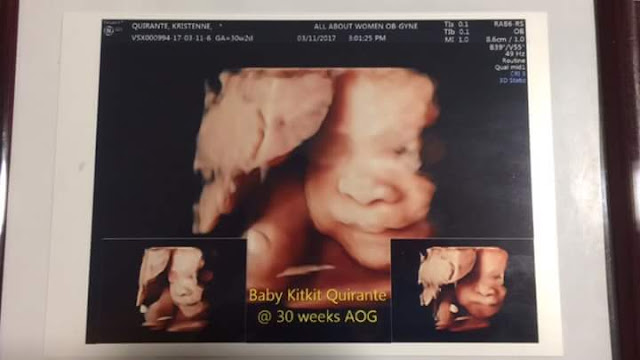 3d ultrasound cebu_gender ultrasound girl