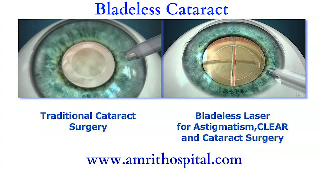 http://www.amrithospital.com/specialities/ophthalmology/bladeless-cataract/