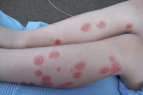 remedios caseros para la psoriasis en los brazos