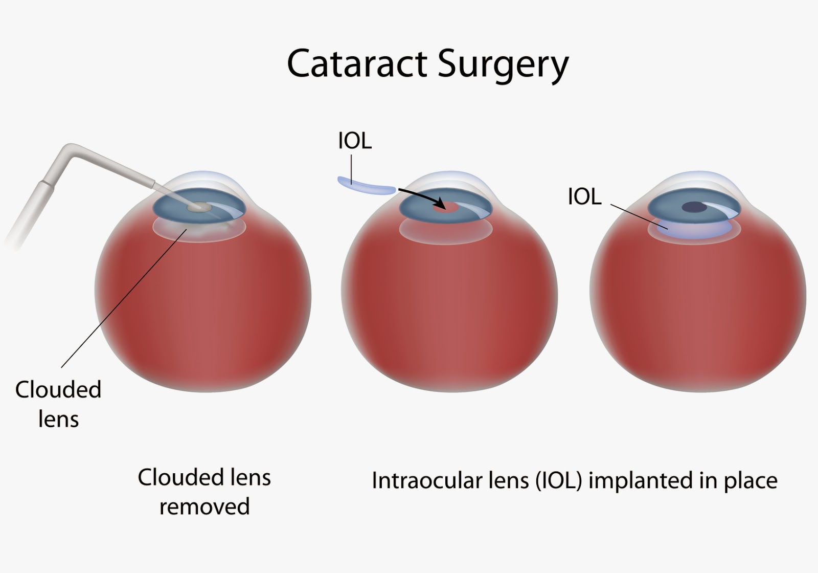 cataract treatment