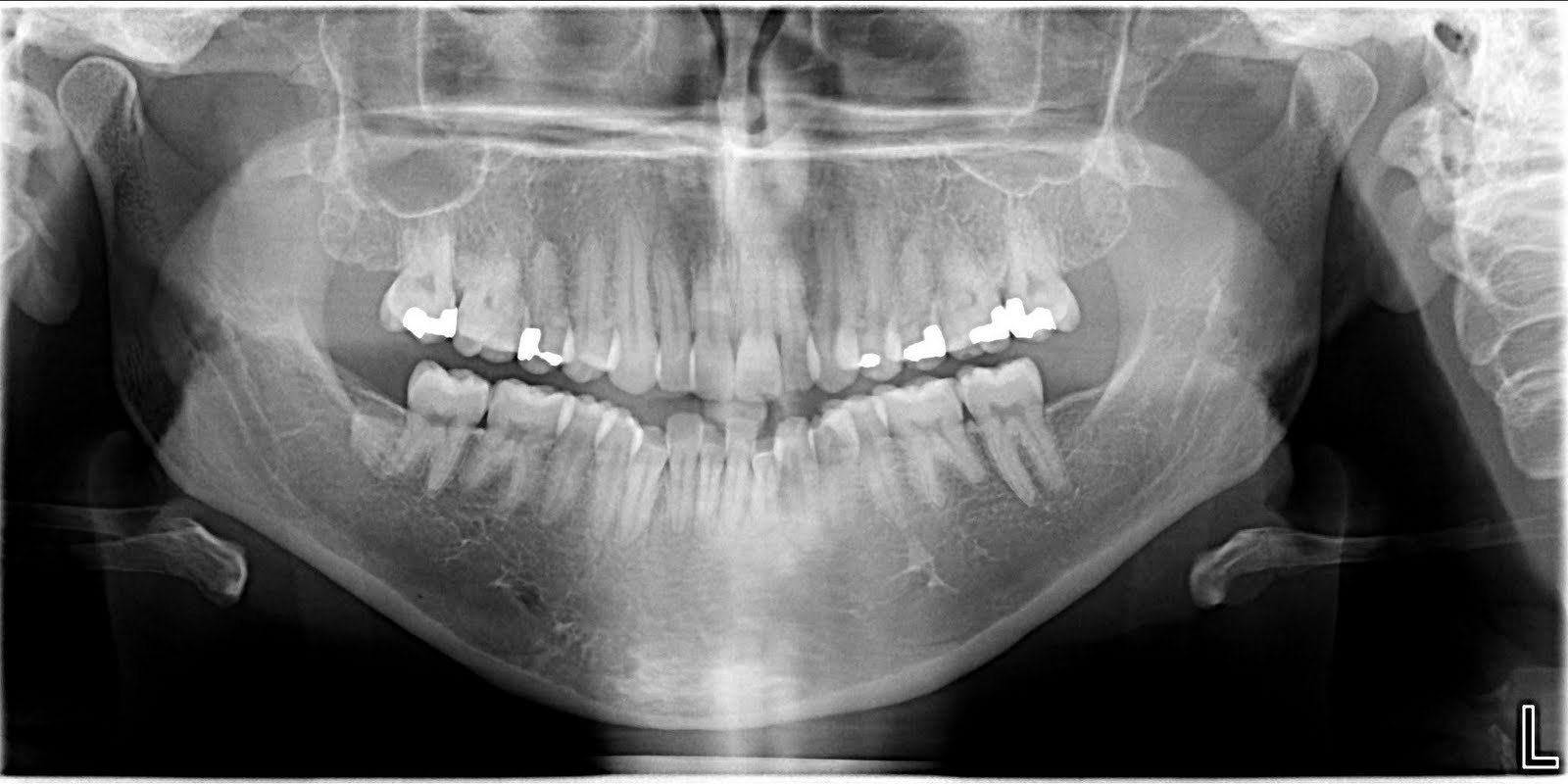 steph's jaw surgery blog xrays