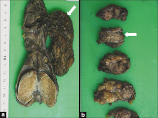 Stages Of Mesothelioma Stages Of Mesothelioma