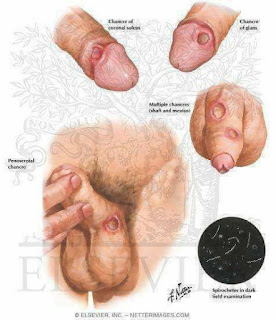 ciri ciri orang terkena sipilis https://www.konfirmasiherbal.com/2018/04/obat-sipilis-serta-contoh-foto-penyakit.html