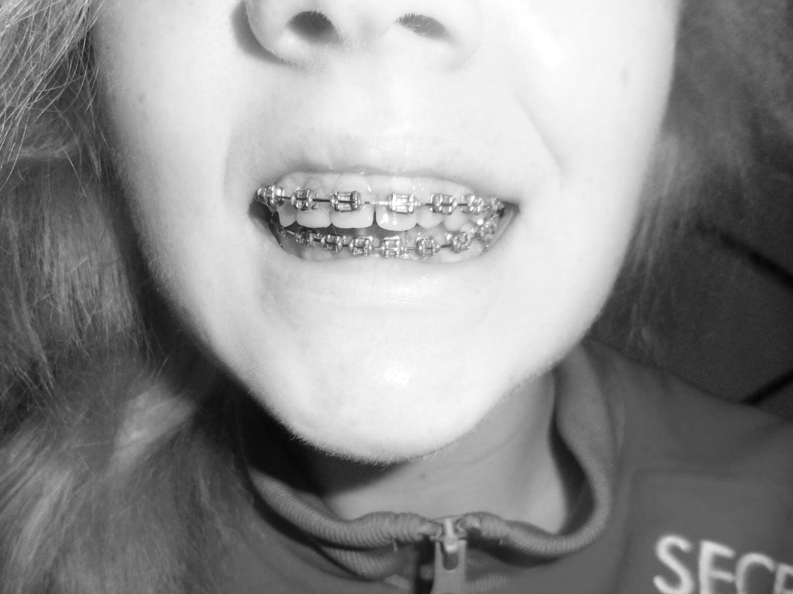 Beth's Lower Jaw Surgery 2012