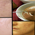 Miracle Cream to Remove Scar Naturally and Permanently
