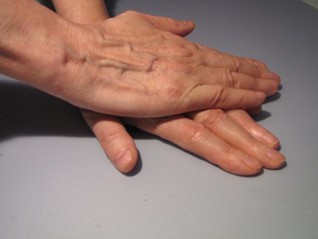 Cannot bend finger into fist congratulate Agree, cannot bend finger into fist aside!
